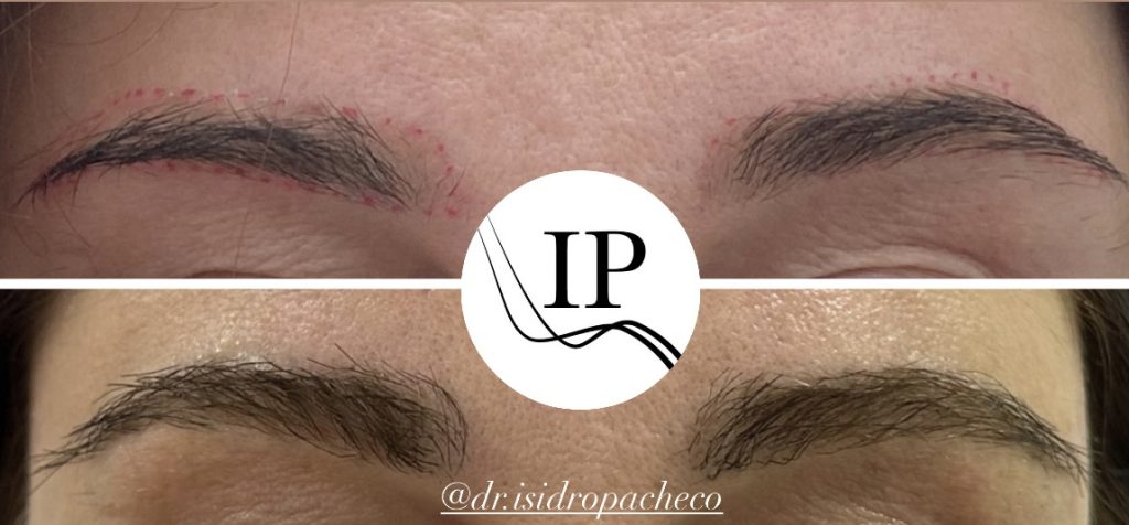 trasplante de cejas en mujeres